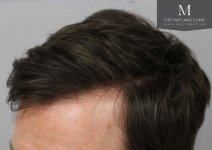 The Maitland Clinic - after_left_hairline.jpg