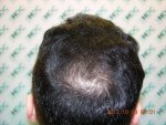 Crown 08-10-12 Pre Op.JPG