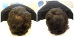 crown example scalp micro pigmentation probeautyclinic.jpg