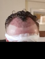Day 0 Post Op.jpg