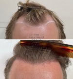 Close-up hairline hair transplant.jpg