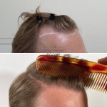 FUE hair transplant before and after with comb.jpg