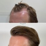 FUE hair transplant result left hairline.jpg