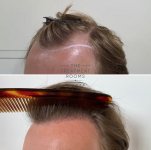 FUE hair transplant result left hairline with comb.jpg