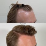 FUE hair transplant result right hairline.jpg