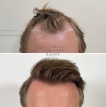 Hairline FUE hair transplant.jpg
