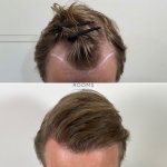 Receding hairline hair transplant result.jpg