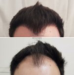 Large FUE hair transplant london before and after.jpg