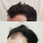 Large left hairline FUE hair transplant london.jpg