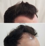 Large Right FUE hair transplant london before and after.jpg