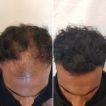 Front hair transplant london.jpg
