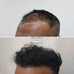 Left FUE hair transplant london.jpg