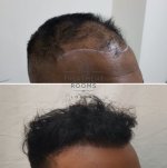 Right FUE hair transplant london.jpg