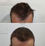 Before and after FUE hair transplant hairline 1452 grafts.jpg
