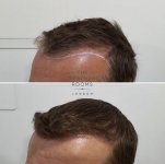 FUE hair transplant hairline 1452 grafts.jpg