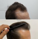 Hair transplant london.jpg
