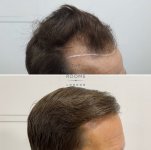 hair transplant result.jpg