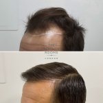 hair transplant result treatment rooms london.jpg