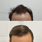 Hairline hair transplant.jpg