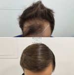 Front hair transplant result.jpg