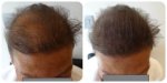 female with extreme hair loss solved with nanogen.jpg