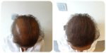nanogen dark brown female extreme hair loss.jpg