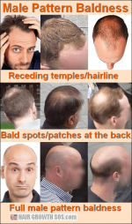 male-pattern-baldness.png