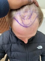 Pre-op Hair.jpg