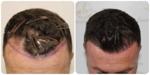dr-bonaros-hair-transplant-glasgow-fue.jpg.jpg