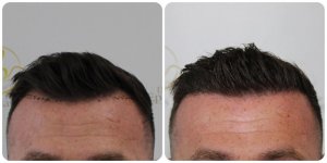 dr-bonaros-hair-transplant-glasgow-dhi-technique.jpg.jpg