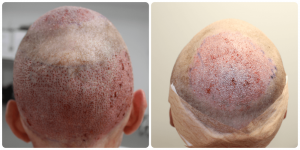 fue-hair-transplant-dr-bonaros-glasgow.png