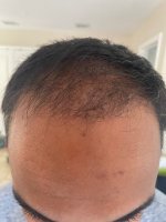 Dr. Ron Shapiro hair transplant6.jpeg