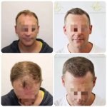 dr-bonaros-hair-transplant-before-after-results-glasgow-receding-hairline.jpg