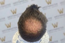 WMG FUE Crown Post Op.jpg