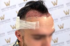 FUE-Hair-Transplant-London-UK-Post Op.jpg FUE-Hair-Transplant-London-UK-Post Op.jpg