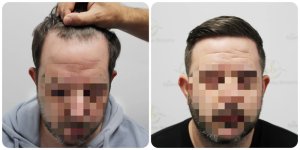hair-transplant-result-glasgow-dr-bonaros (2).jpg