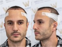 WMG London hairline FUE post op.jpg