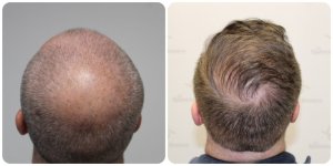 crown-hair-transplant-glasgow.jpg