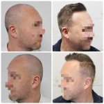 dr-bonaros-12-months-result-hair-transplant-scotland (6) (1).jpg