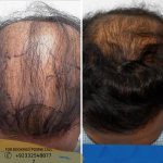 Hair transplant before after results.jpg