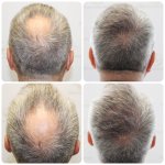 dr-bonaros-12-months-result-hair-transplant-scotland (15) (2) (1).jpg
