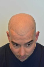 Front before 3rd Procedure shaved.jpg