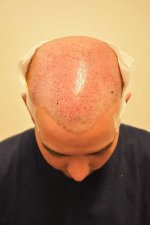 after 3rd procedure April 2nd 2025.jpg