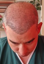Front and vertex 2 weeks post 3rd procedure.jpg
