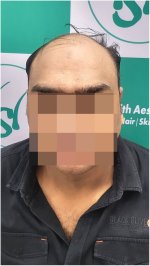 Before Hair Transplant HS 824- The Hairsmith Clinic Delhi India (1).jpg