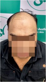 Before Hair Transplant HS 824- The Hairsmith Clinic Delhi India (2).jpg