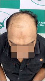 Before Hair Transplant HS 824- The Hairsmith Clinic Delhi India (3).jpg
