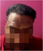 The Hairsmith Hair Transplant Result - After 8 Months Update.jpg