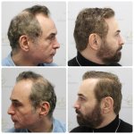 hair-transplant-12-months-result-glasgow-dr-bonaros (16).JPG