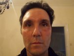 9hrs Post Op Full Face 16-05-16.JPG